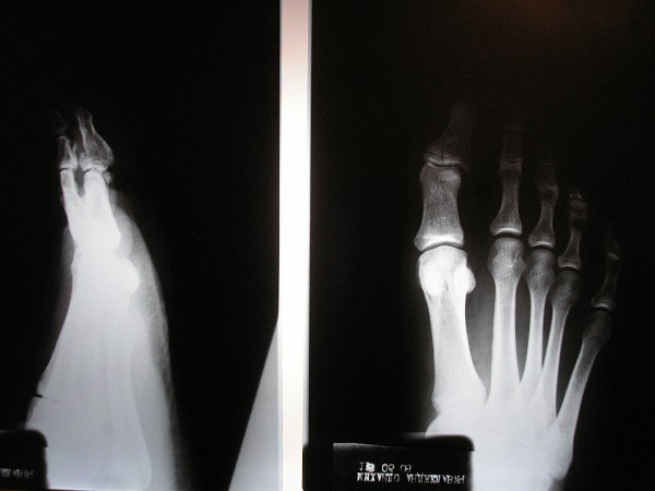 x-ray of broken foot